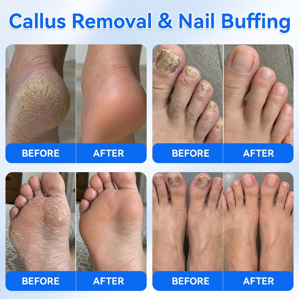 ⭐Ivanoir® Upgraded Multi-Function Nail & Callus Care Pen With UVA Light––👣 Callus & 💅Nail