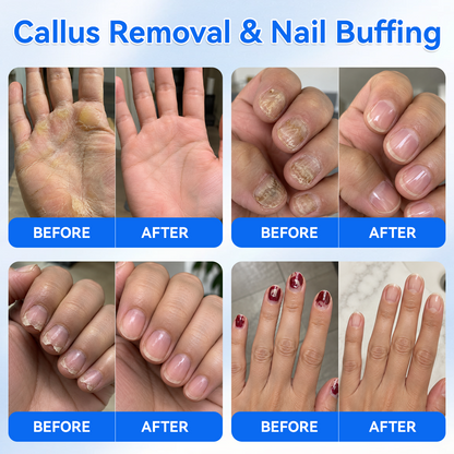 ⭐Ivanoir® Upgraded Multi-Function Nail & Callus Care Pen With UVA Light––👣 Callus & 💅Nail